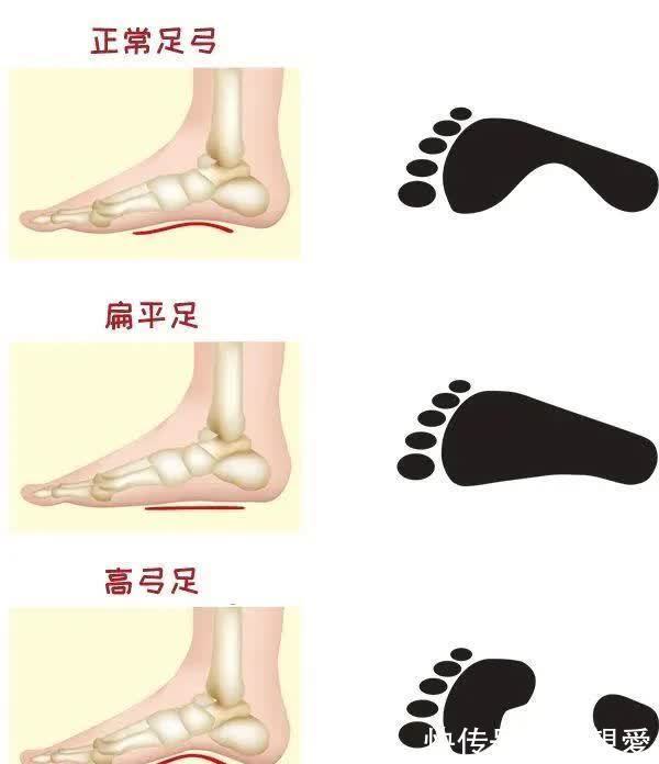 髋关节|孩子这样走路,暗示发育出现大问题!越早发现越好!