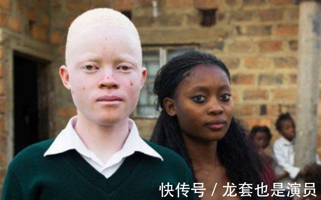 病人@非洲版“唐僧”:皮肤全白,血液比黄金还贵,死后遗骸能卖上百万