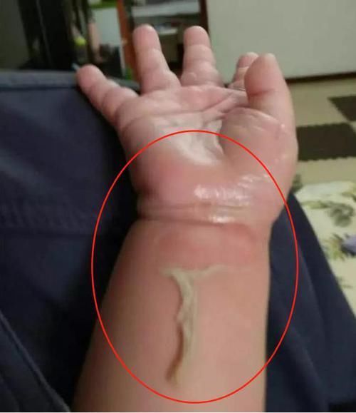 伤口|孩子烫伤后只有2分钟紧急处理,做错这一步,可能加重孩子的伤情