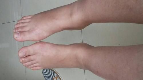 冠心病|血管堵寿命短！医生：1种粗粮常吃，软化血管，清除血管垃圾