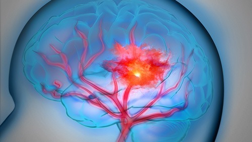 患者|50岁后，进入“生命高危期”，不想脑出血，少做哪些事情