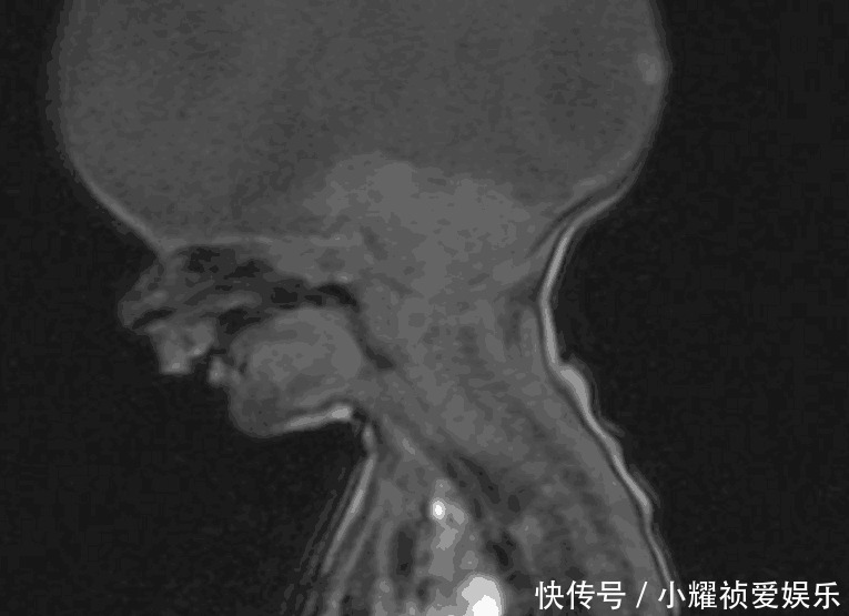 大脑|国外男婴出生没大脑, 医生说活不了几天, 现在已2岁会喊妈妈