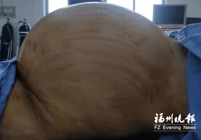 卵巢|48斤！女子体内取出超大肿瘤