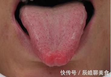 糖尿病|80后精神小伙患2型糖尿病,医生感叹太年轻,5种舌象很常见要当心