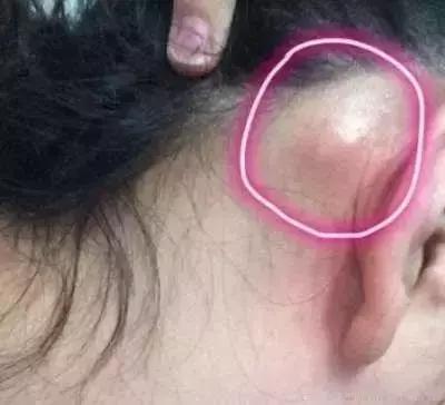 淋巴结|小心！耳朵后面长个小疙瘩不痛也不痒，上医院一查竟是肺癌