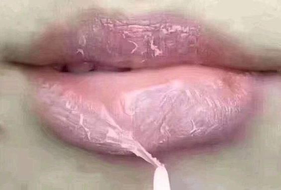 嘴唇|嘴巴上出现死皮,一撕一长条钻心疼?4种病作祟,看完立马停手