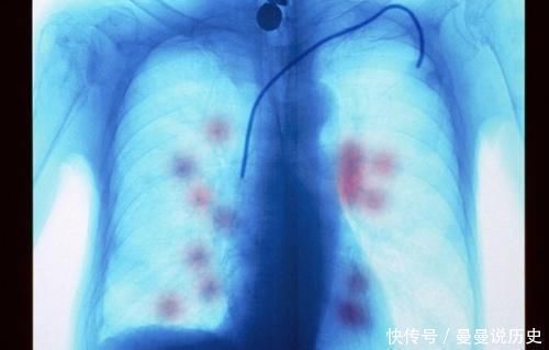 肺部“闪现”癌,并非悄无声息,此3种表现,可让它露出“马脚”