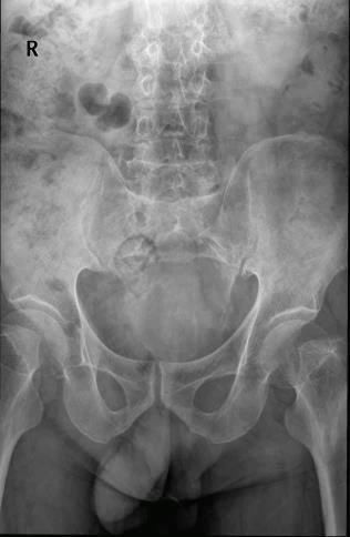 椎体|脊柱常见肿瘤及肿瘤样病变的几种影像学表现,你都见过吗?