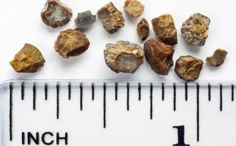 藏身之地|德州市中医院:钬激光碎石让“石”无藏身之地