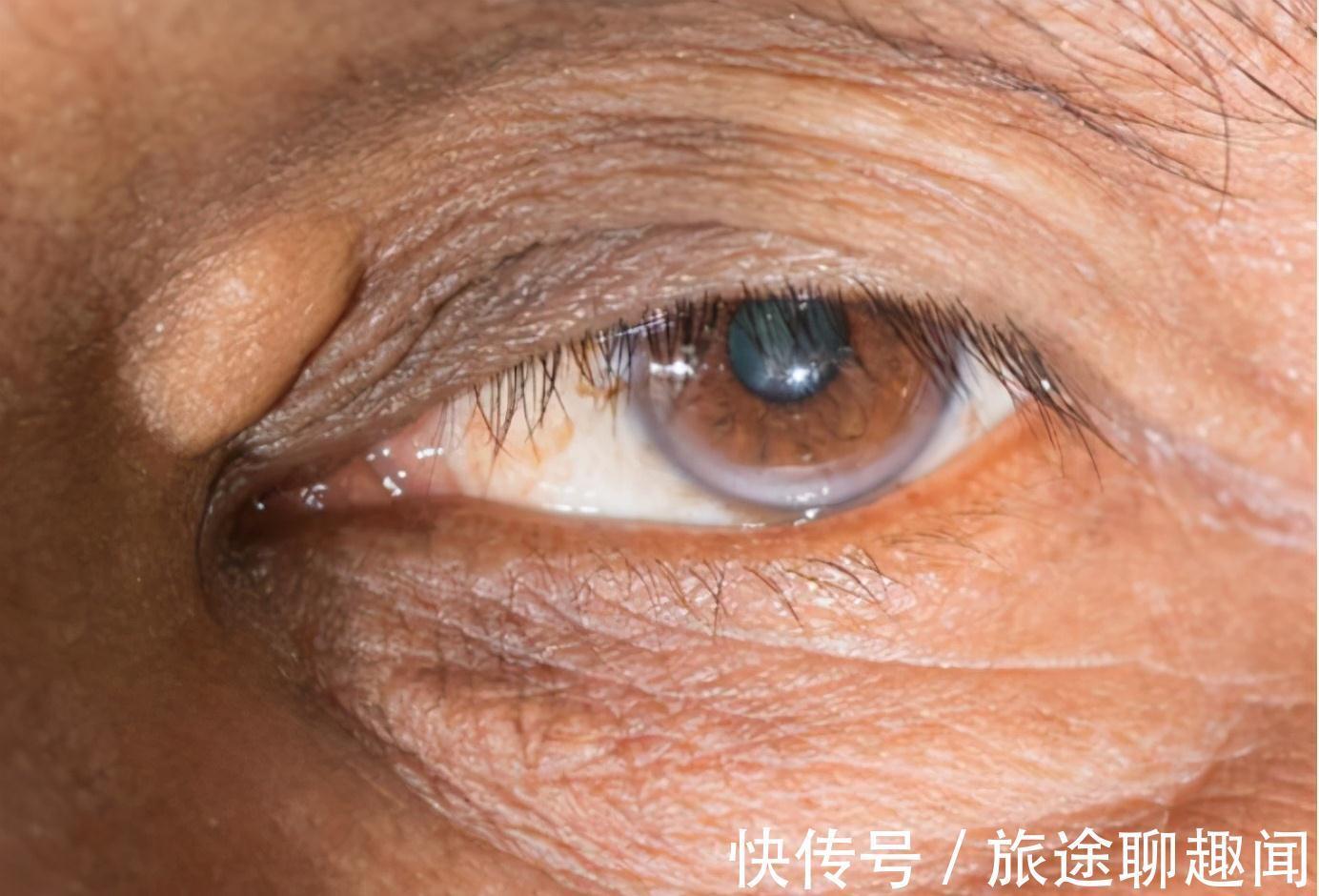 牛油果|高血脂需戒掉的不是“大鱼大肉”,而是2种“水果”,劝你管住嘴