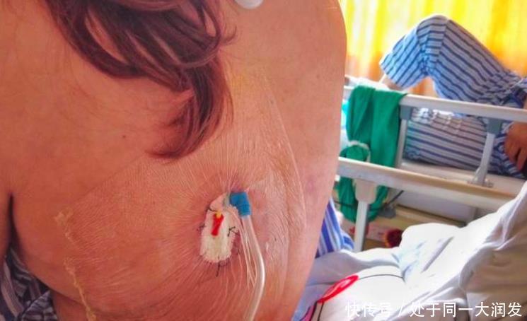 创口|女子去医美抽脂,背部创口溃烂缝不了针,竟仍选择做双腿吸脂手术