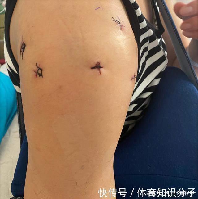 中国女排|8颗钉植入右肩,颜妮手术顺利报平安,她是中国女排永远的北长城