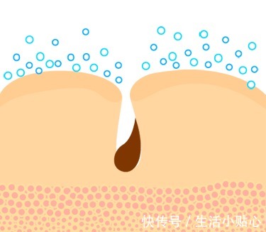 油脂|毛孔粗大应当重视毛孔清洁问题,毛孔干净了,颜值自然上去了