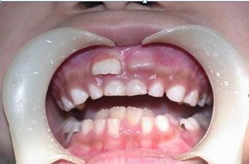 男孩|7岁男孩长出“双排牙”,要一颗一颗拔掉,奶奶自责不已,赖我啊