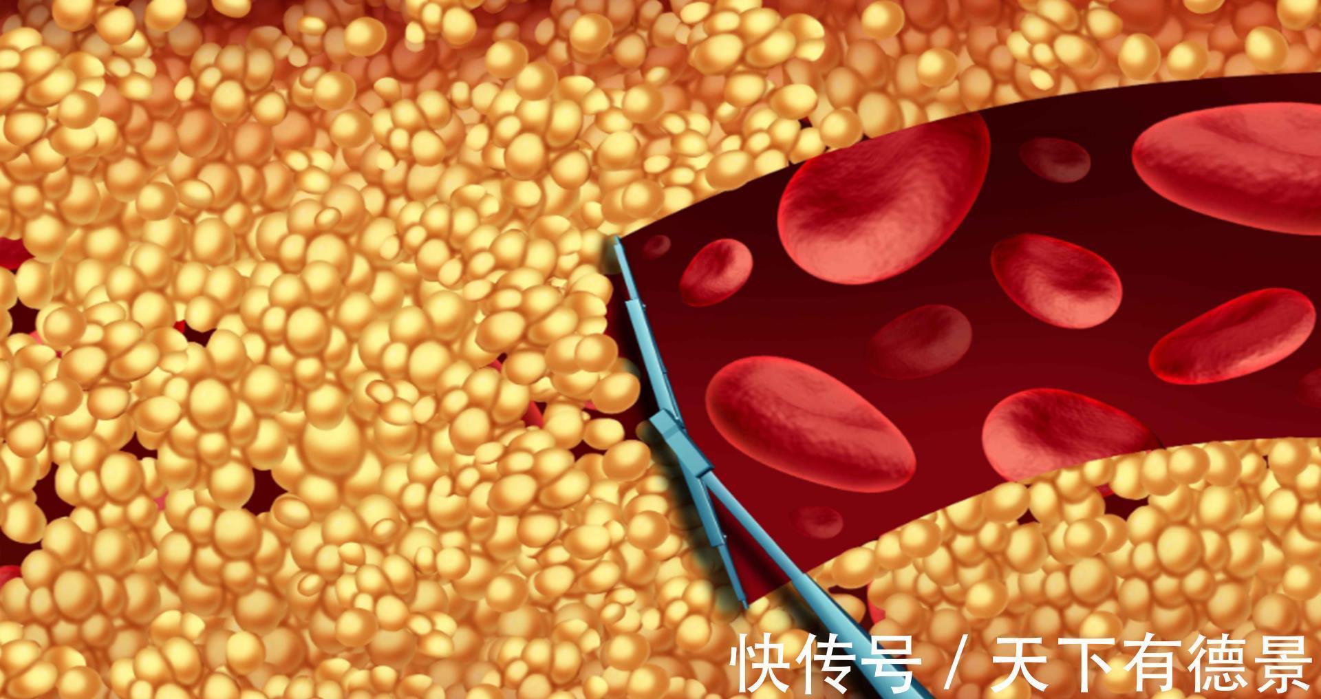 高血压|保持血管通畅,降血压有方法?高血压建议常吃3种食物