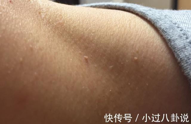 硒优素|宫颈癌都是HPV拖出来的，易于皮肤病混淆，提醒：这种疙瘩需注意