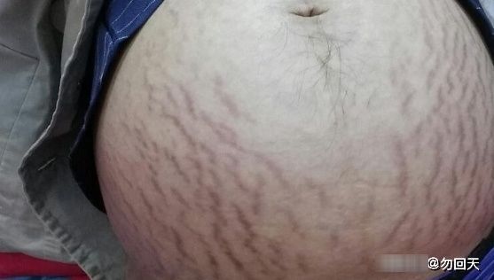 孕妈|有些孕妈为何会出现“妊娠纹”,但有些孕妈却没长?大夫讲了内情