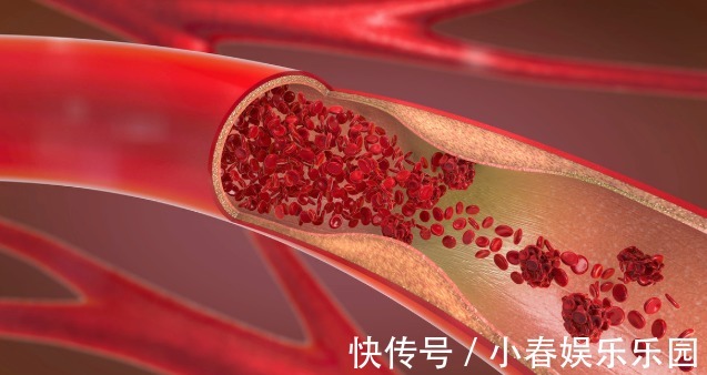 血管|走路能防血栓?医生:记住“三五七”原则,血栓绕道走