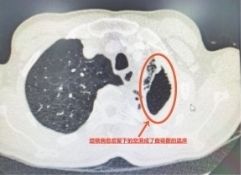 结核病|一咳就“吐丝” 吐的竟是曲霉菌丝