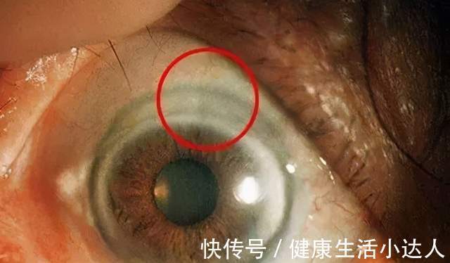 碳水化合物|血脂高了危害大，提醒：一旦臉上出現3種變化，要注意忌口了