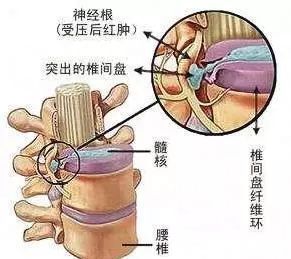 腰间盘突出，坐立难安！这样坚持十天，腰再也不“突出”！