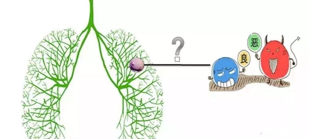 x光片|肺肿块或结节，一定是肺癌吗？