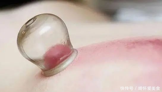 湿气|拔火罐到底吸出来是湿气,还是毒素?答案或和你想的不同
