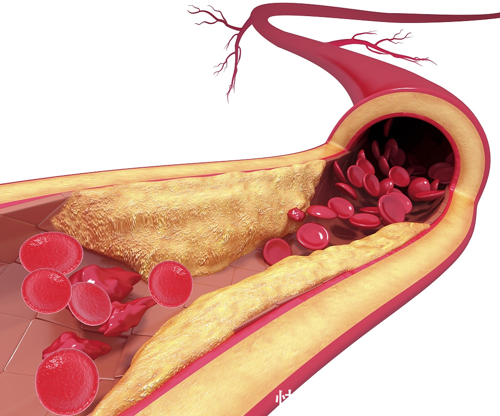 高血压|白粥加咸菜是最佳拍档医生常吃恐增加这些疾病风险,要管住嘴