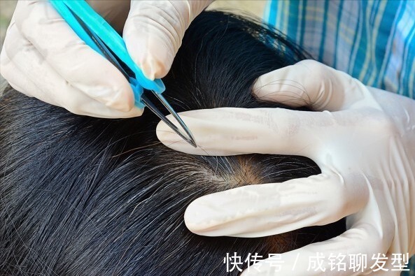 假发片 40岁头顶的头发都白了,不想染发,有啥好办法让白发变黑发吗?