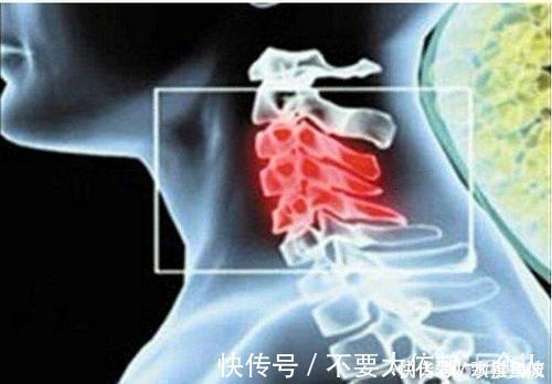 椎动脉|颈椎安康：得了颈椎病不要怕，四个防护方法助您保护您的颈椎