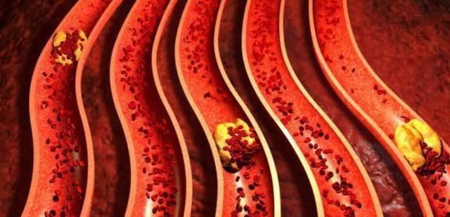 饮食|吃素能降血脂吗？医生：掌握三个饮食原则，血脂或会好转