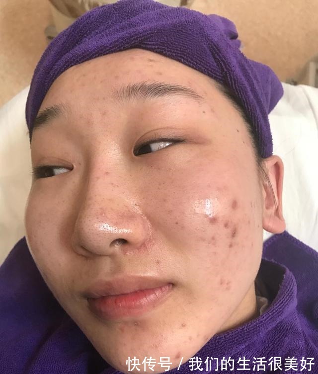 后感 M22光子嫩肤后感!