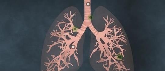 疼痛|肺癌一发现都是晚期错早期往往有蛛丝马迹,是身体在向你求救