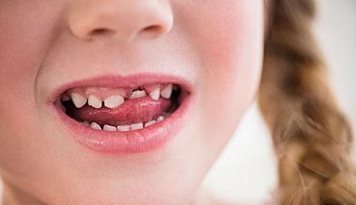 男孩|15岁男孩长出“尖牙”,妈妈亲手摸过后吐槽:养了个“吸血鬼”