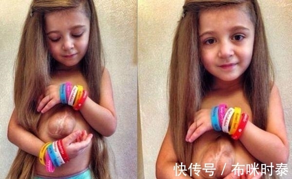 五联症|6岁小女孩患罕见怪病,心脏长在身体外,用微笑感动无数人