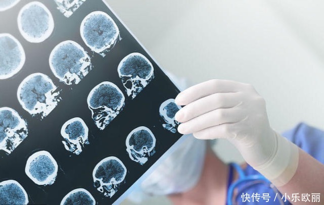 46岁大姐脑梗离世，医生劝诫：厨房一种调料是祸根，害了不少人