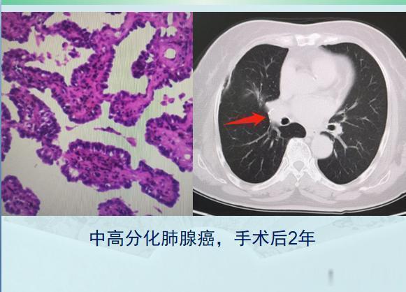 原发灶|两个肺癌病人都拖了2年才治疗，一个治愈，一个扩散了