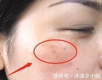 黑眼圈|子宫好的女人, 脸上可能有这4个现象? 你若占1个, 子宫还很健康