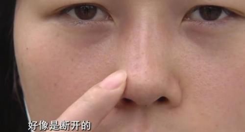 严女士|女子花了4万做整容,鼻子却留下一个坑?美容院:术前已告知风险