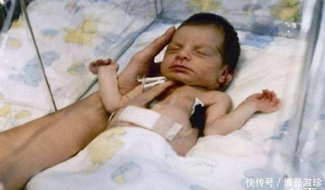 器官|动物心脏首次成功移植人体,手术圆满成功,不料21天后意外出现