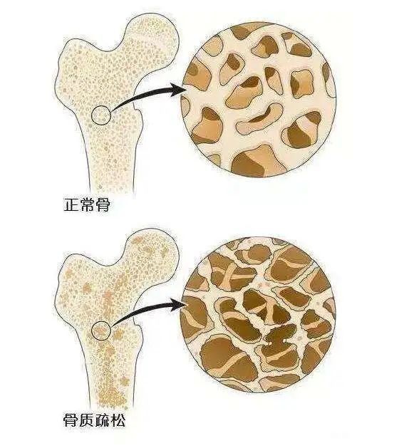 骨质量|关注骨骼健康，远离骨质疏松