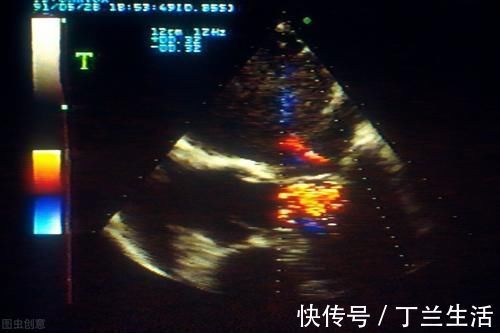 检查|什么是心脏彩超？能检查出什么疾病？听听医生怎么说