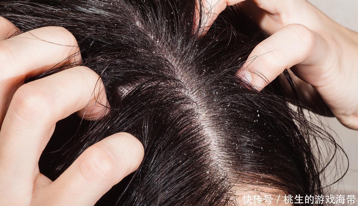 头皮|为何每天都洗头,可头发还是很油?或许跟5个原因有关,早作了解