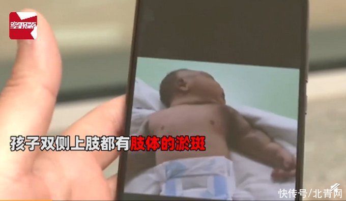 新生男婴三天后患“怪病”，一碰就出血！满身淤青让人心疼