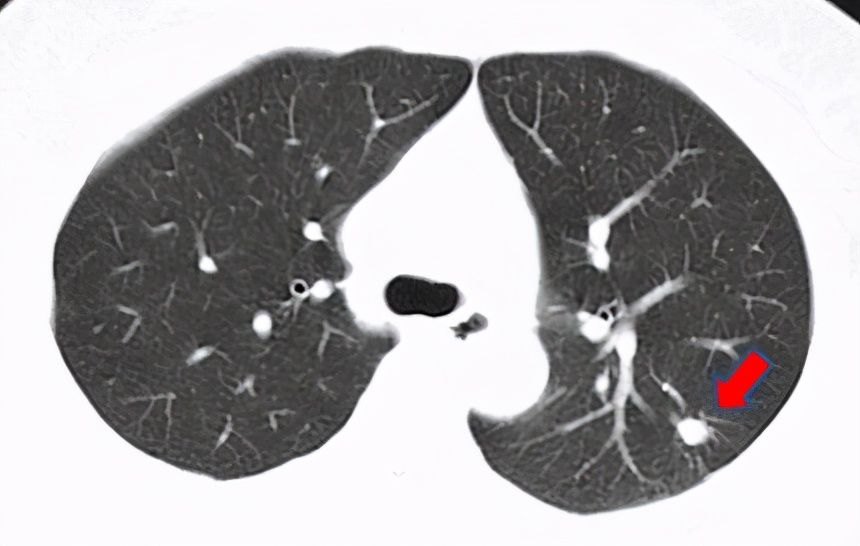 结节|刀下“留肺”!容易误认为癌性“肺结节”的8种感染