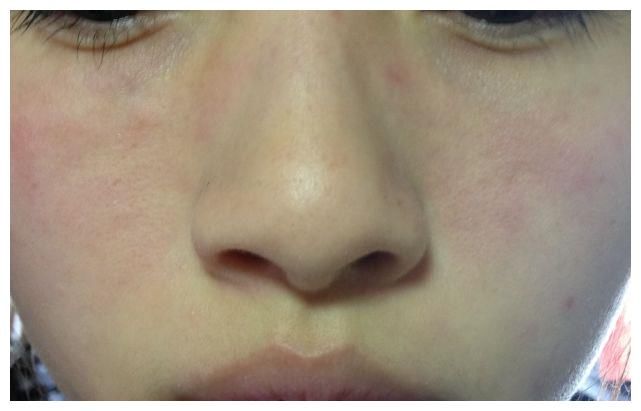 35岁女子激光祛斑遭毁容，皮肤科医生：风险太大，建议这样保守祛斑