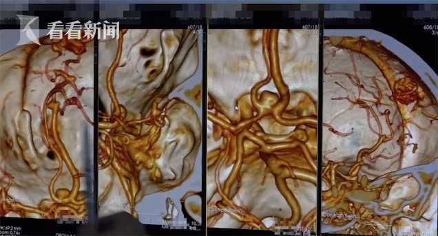 头疼|女子洗澡时突然头疼 医生在脑中发现7个“炸弹”!冬季这类人要注意