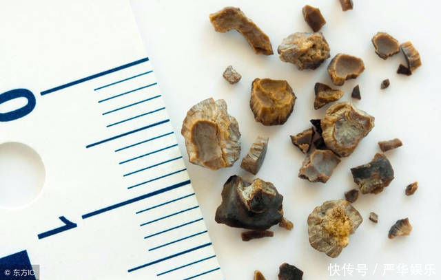 胃黏膜|母子二人先后查出胃癌,丈夫痛哭,很多人早餐爱吃