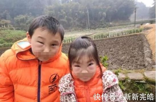 肥皂水|哥哥带着妹妹捅马蜂窝,却被蛰成“猪头”,妈妈迟迟不敢相认