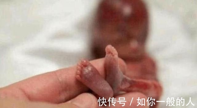 婴儿|在妈妈肚子里呆了22周，出生体重仅有245克，世界最小婴儿